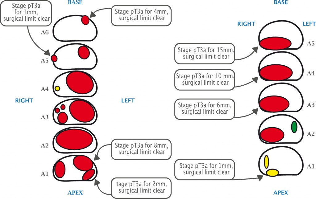 Postoperative histology in two patients with high volume tumours correlates well with preoperative MRI, using colour coding to show likelihood of clinically significant disease on MRI (red – highly likely, yellow – equivocal, green –unlikely). Source: Courtesy of John Kelly, Division of Surgical & Interventional Science, University College London