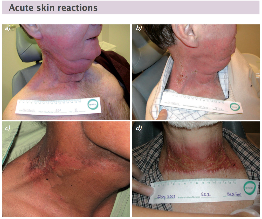 Acute radiation skin reactions start as erythema (a). If the reaction continues, dry desquamation occurs (b and c), which may be followed moist desquamation (d) Figures courtesy of Lena Sharp