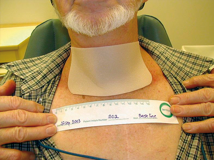 Common skin reactions in patients receiving breast radiation therapy.