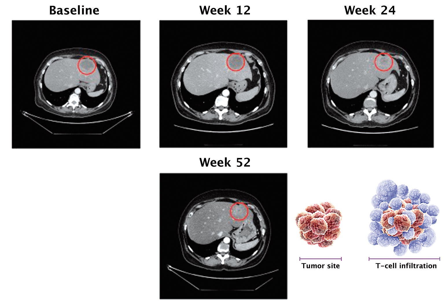 The role of immunotherapy in treating solid cancers | Cancer World Archive