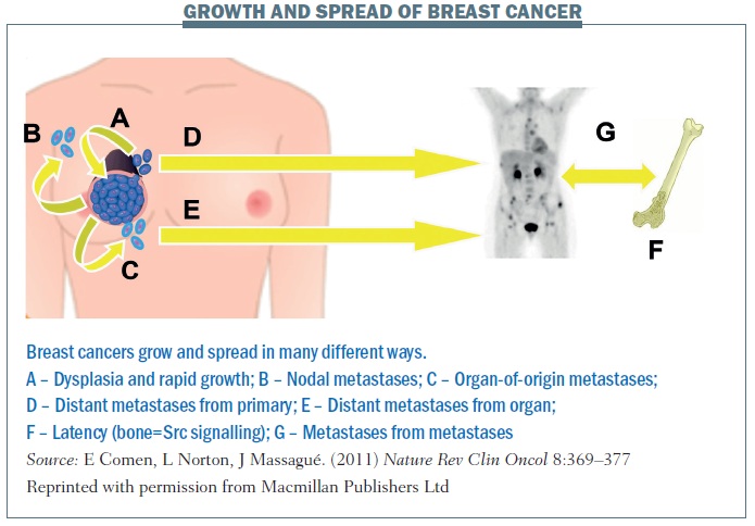 Breast Cancer Growth Rate: Time to Develop and Spread