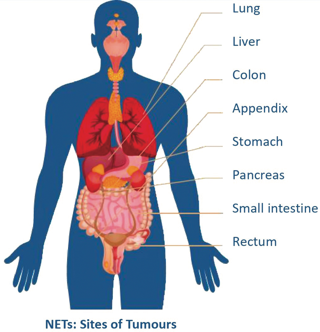 Net Cancer NETs – Why this master of disguise needs careful handling | Cancer ...